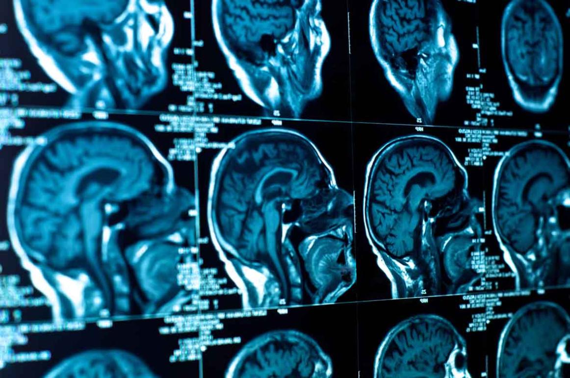 Can Brain Scans Predict Criminal Behavior?